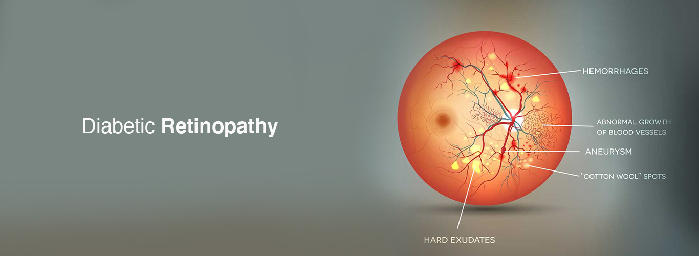 Diabetic Retinopathy